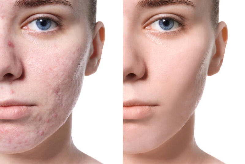 Dve sliki iste ženske, na eni ima akne, na drugi je brez
